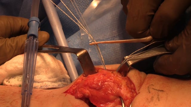 Proximal Patellar Realignment: Trochleoplasty, MPFL Reconstruction and Biologic Patellar Resurfacing