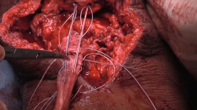 Chronic Patellar Tendon Reconstruction After Failed Repair