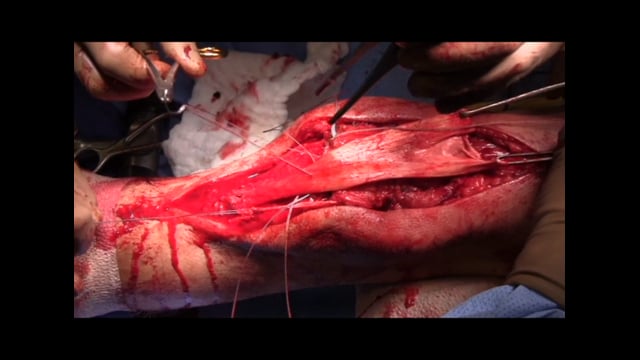 Chronic Patellar Tendon  Reconstruction