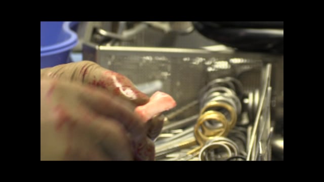 Revision Latarjet Procedure with Distal Tibial Allograft and Conjoint Tendon Transfer