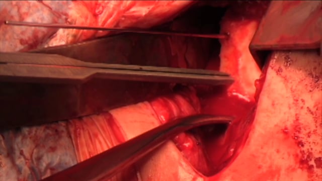 Revision Latarjet Procedure with Fresh Distal Tibial Allograft and Conjoint Tendon Transfer