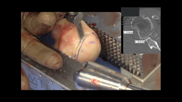 Open Shoulder Stabilization Using Humeral and Distal Tibial Allografts