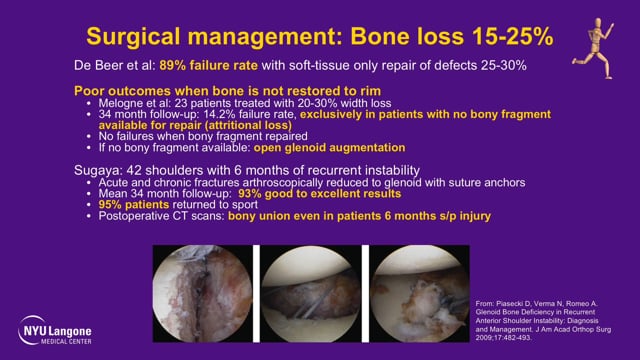 Arthroscopic Bony Bankart Repair for Traumatic Shoulder Dislocation