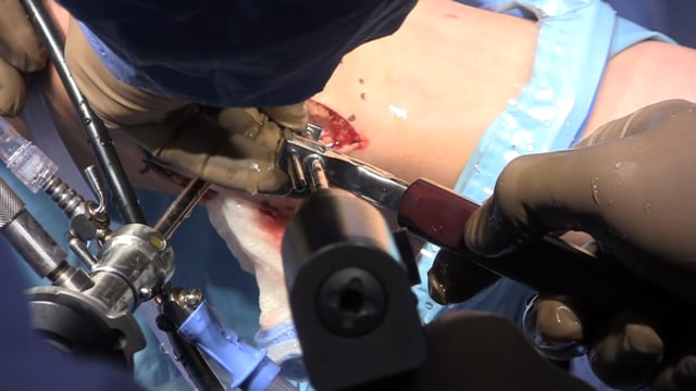 Meniscal Allograft Transplantation Made Simple: Bone Bridge Slot Technique