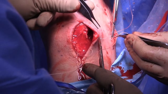 Meniscal Allograft Transplantation Made Simple: Bone Plug Technique and ACL BTB Autograft