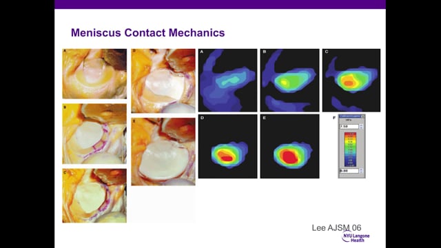 Meniscus Preservation: Resection and Repair Strategies