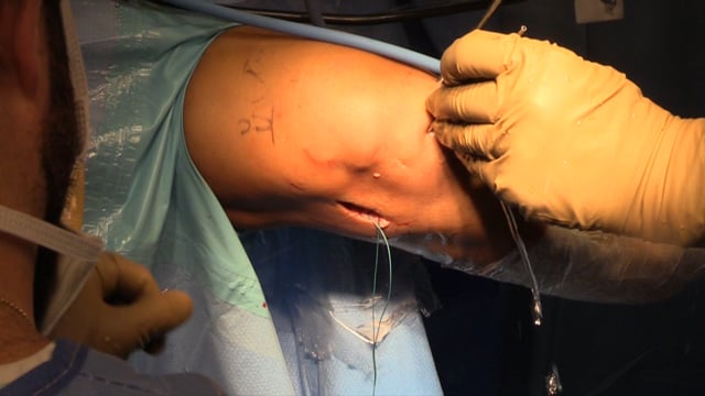 Lateral Meniscal Transplantation via a Bone Trough Technique