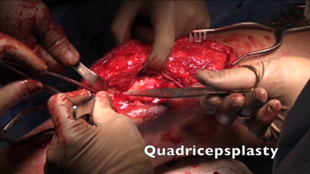 Revision Lateral Femoral Condyle ORIF with Quadricepsplasty and MPFL Reconstruction