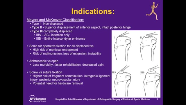 Tibial Spine Avulsion Fracture