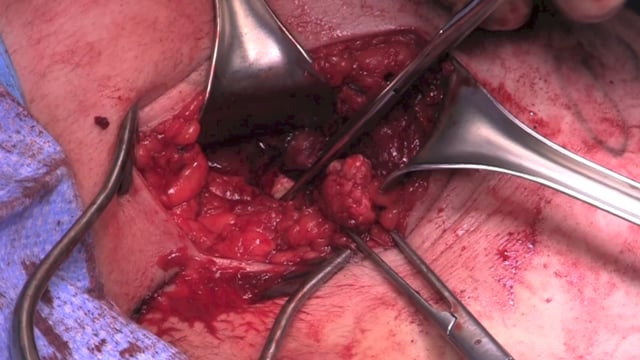 Proximal Hamstring Rupture Primary Repair with Suture Anchor Technique