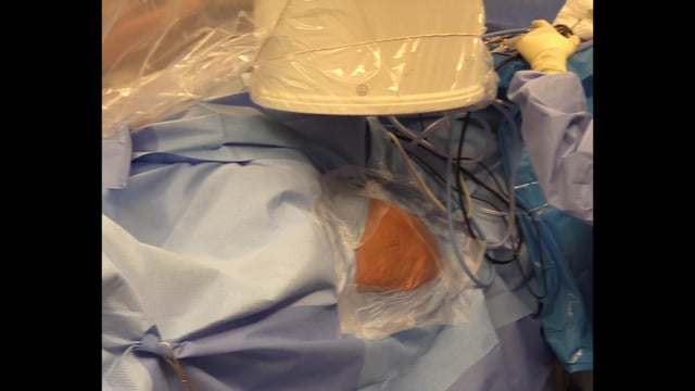 Gluteus Medius Repair Using a Collagen Based Bioinductive Implant