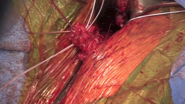 Proximal Adductor Longus Repair with Fiberwire Suture Anchors