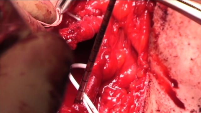 Revision Distal Biceps Tendon Repair: Tips, Tricks and Pearls for Successful Outcomes