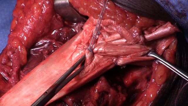 Chronic Distal Biceps Tendon Rupture Reconstruction with Achilles Tendon Allograft