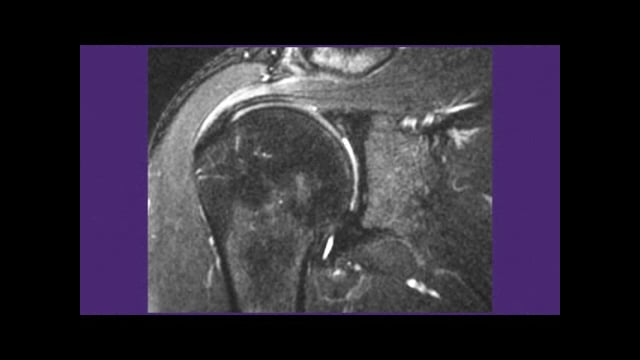 MRI – Arthroscopic Correlations in the Upper Extremity