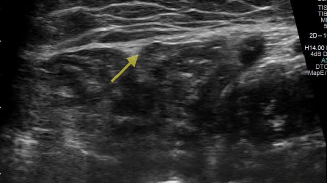 Chronic Exertional Compartment Syndrome of the Lower Extremity: Diagnosis, Management, and Surgical Technique