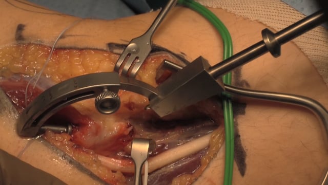 UCL Reconstruction: Modified Jobe Technique