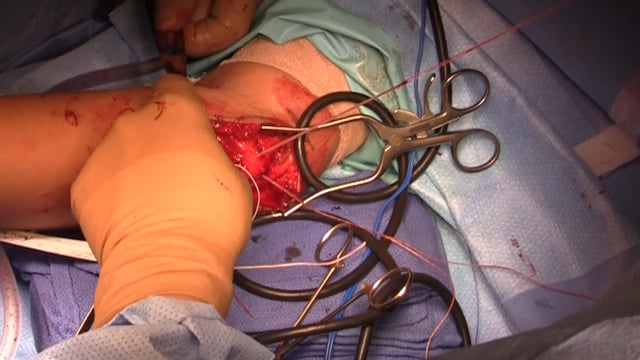 Ulnar Collateral Ligament Reconstruction: Docking Technique