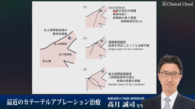 最近のカテーテルアブレーション治療