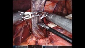 Robotic Hiatal Hernia Repair with Diaphragm Release