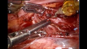 Robotic Heller Myotomy via Thoracic Approach