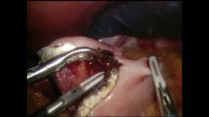 Laparoscopic Gastric Bypass