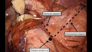 Laparoscopic Wedge Collis Gastroplasty