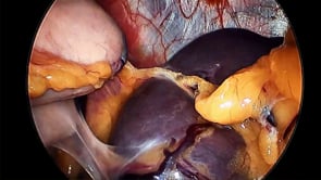 Laparoscopic Sleeve Gastrectomy