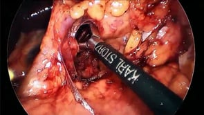 Laparoscopic Gastrectomy