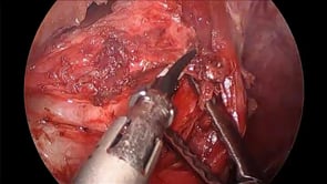 Laparoscopic Epiphrenic Esophageal Diverticulectomy