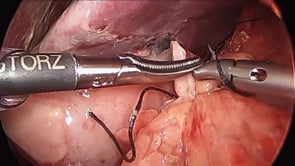 Laparoscopic Duodenal Perforation – Graham Patch