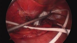 Laparoscopic Gastric Band Removal