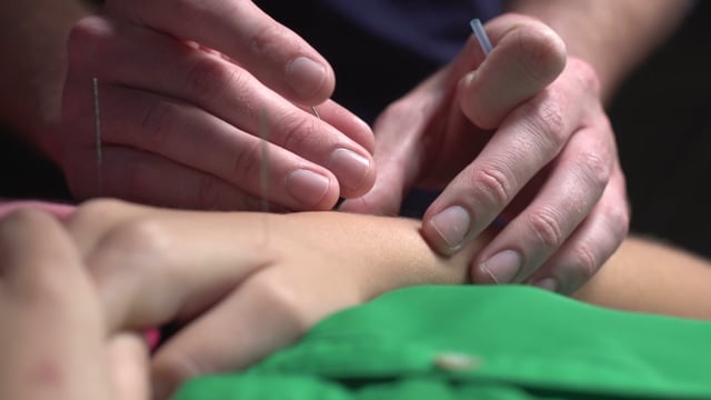 Medical Acupuncture - Video Thumbnail