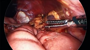 Laparoscopic Billroth II Reconstruction