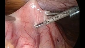 Laparoscopic Cystogastrostomy