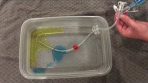 Laparoscopic Jejunal Tube Placement