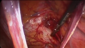 Laparoscopic TAPP Femoral Hernia Repair