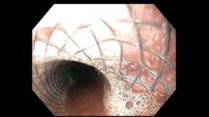 Endoscopic Esophageal Covered Stent Placement