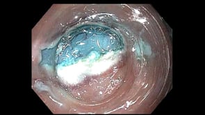 G-POEM (Gastric Per Oral Endoscopic Myotomy)