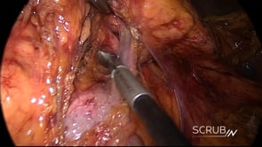 Laparoscopic Distal Pancreatectomy & Splenectomy