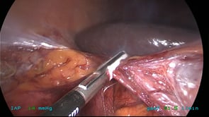Laparoscopic Right Colectomy