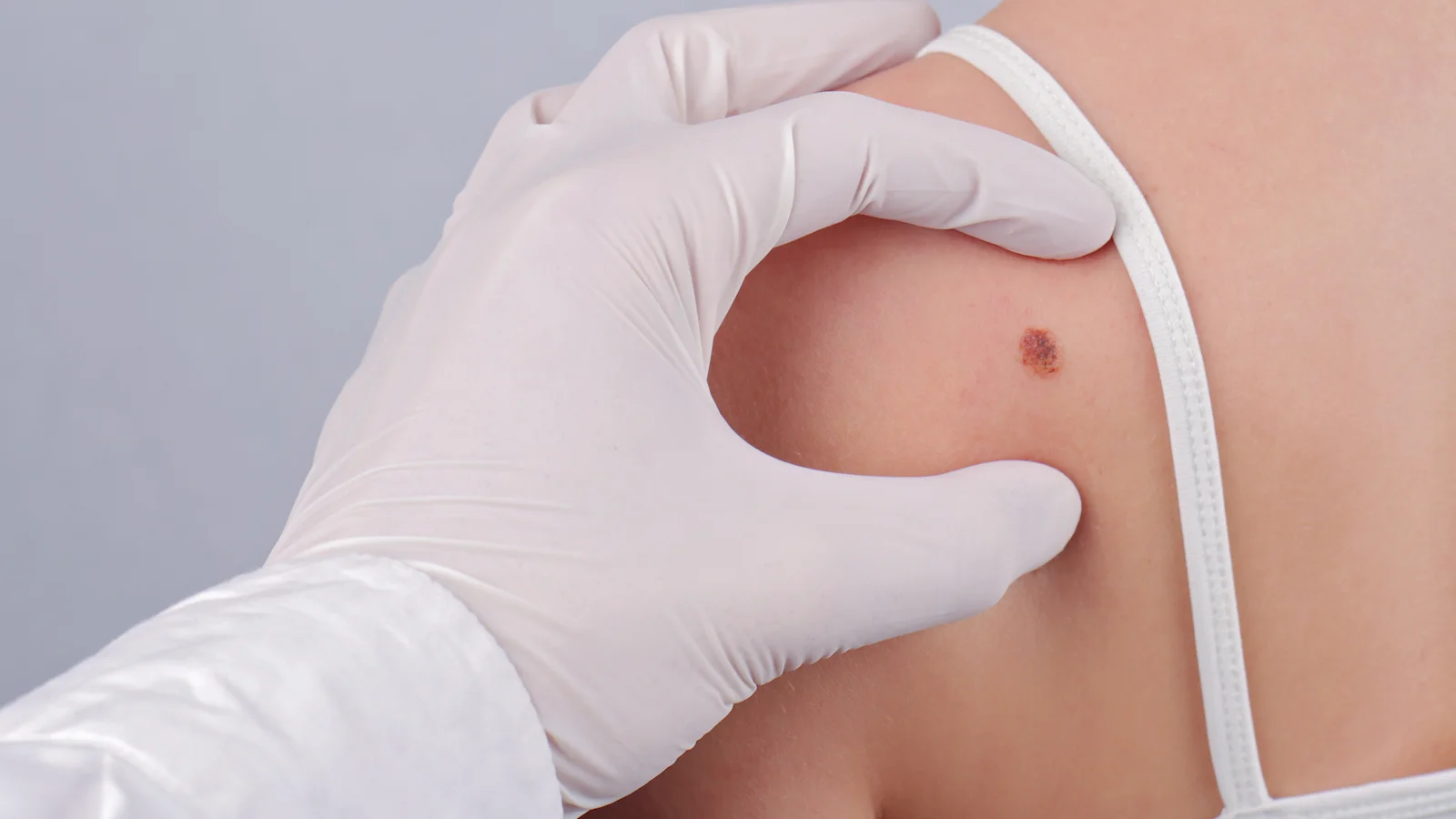 melanotic sarcoma is a skin cancer that begins with quizlet Flashcards - Tumors Detecting Melanoma with the ABCD