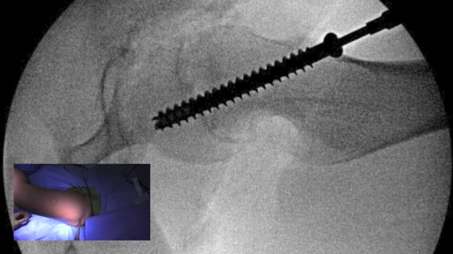 In Situ Fixation for Stable Slipped Capital Femoral Epiphysis