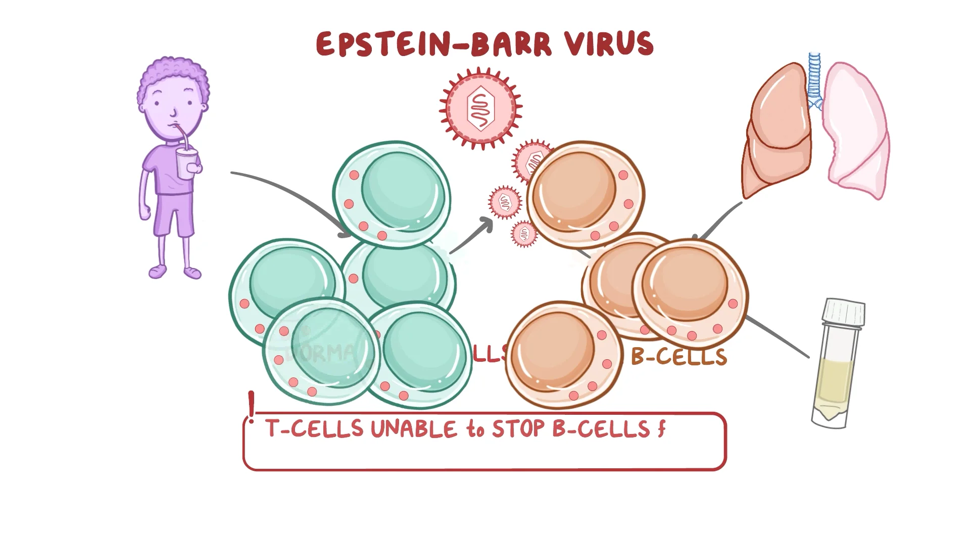 Posttransplant Lymphoproliferative Disorder