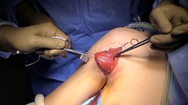 Primary Repair of a Chronic Pectoralis Major Tear with Retraction