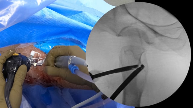 Arthroscopic Hip Labral Repair and Lesser Trochanter Excision for Ischiofemoral Impingement