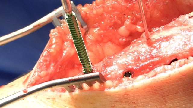 Tibial Tubercle Anteromedialization and Distalization and Arthroscopic Lateral Release