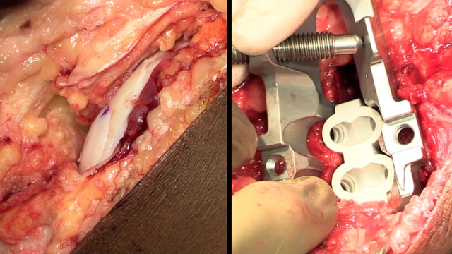 Medial Femoral Condyle Osteochondral Allograft Transplantation and Medial Opening Wedge High Tibial Osteotomy