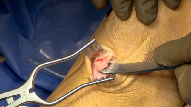 Osgood-Schlatter Ossicle Resection and Tuberoplasty with Suture Anchor Repair of Patellar Tendon