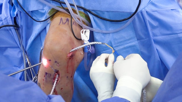 PCL Reconstruction in an Athlete with a Multiligament Knee Injury